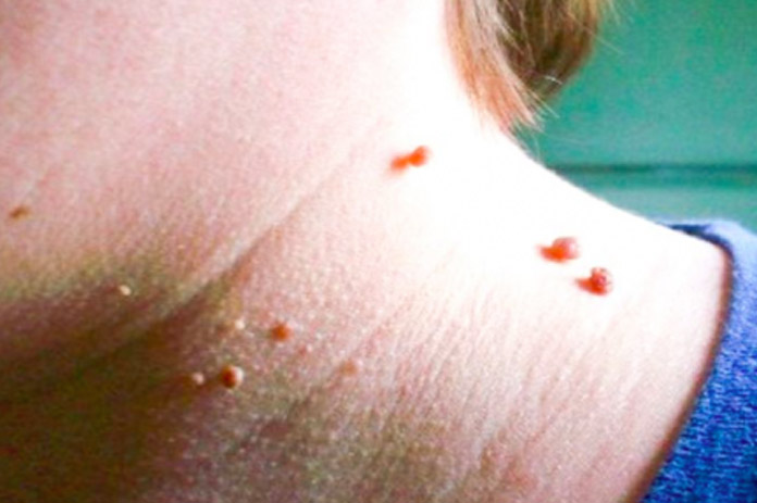 Mengatasi Masalah Skin Tags (Kelebihan Kulit) dengan Cuka Apel